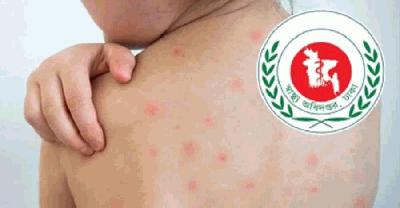 হাম ও উপসর্গে আরো দুজনের মৃত্যু, প্রাণহানি ছাড়াল ৪৫০