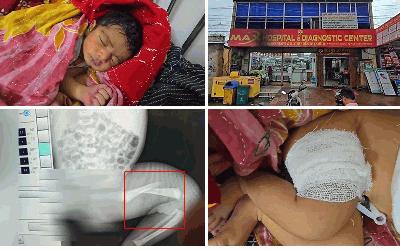 কলাপাড়ায় হাসপাতালে নবজাতকের পা ভাঙার অভিযোগ
